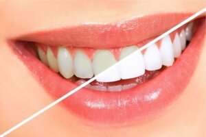 Професійне відбілювання зубів: сучасні методики