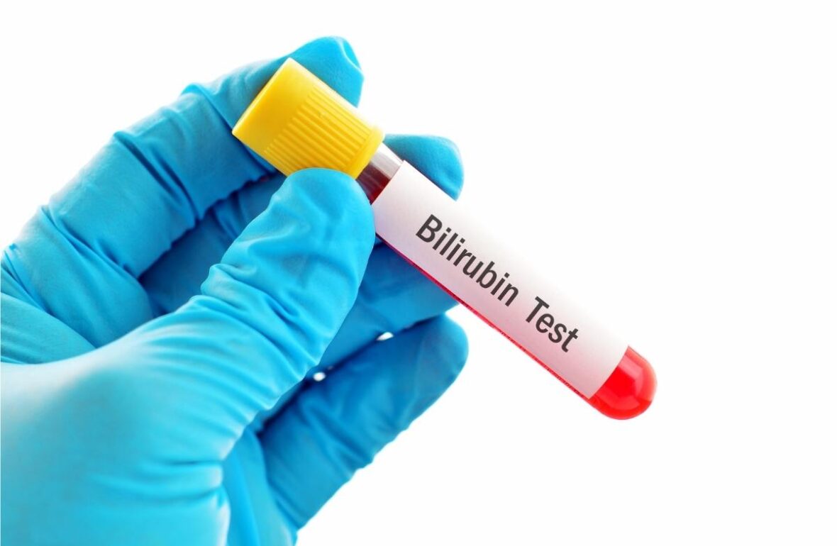 високий білірубін