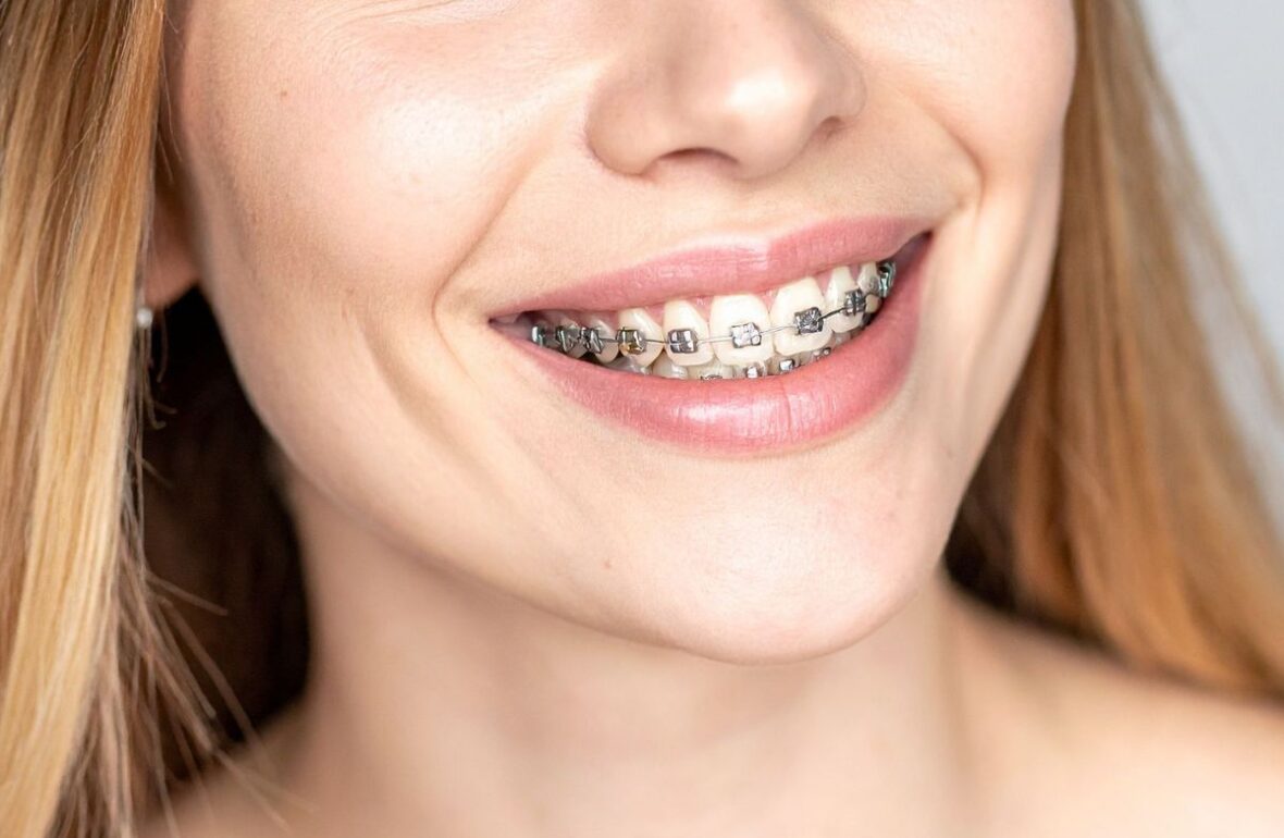 брекети для дорослих