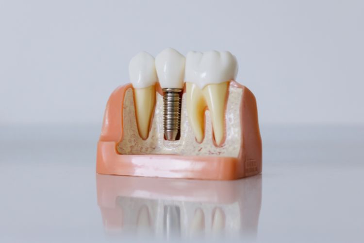 зубні імпланти