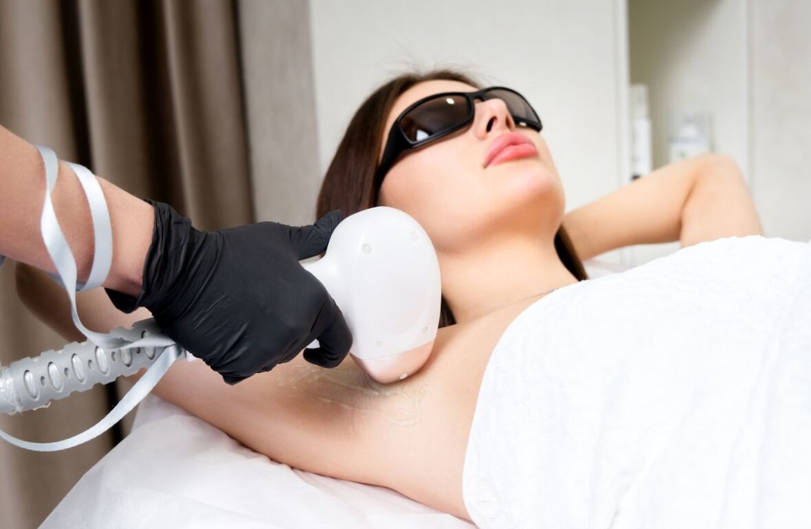 лазерна епіляція