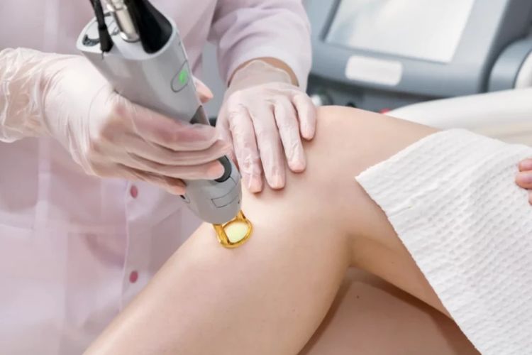 лазерна епіляція