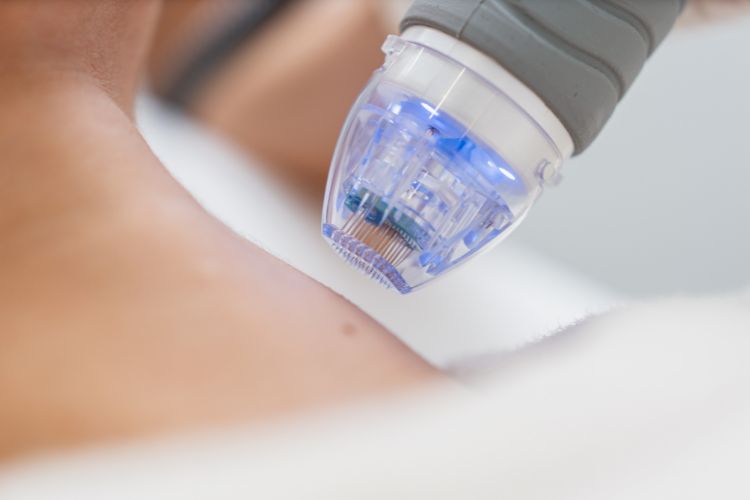 Мікрогольчастий RF-ліфтинг